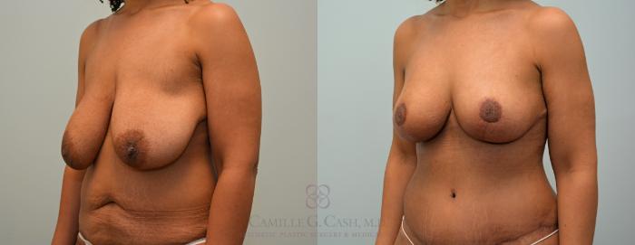 Before & After Breast Lift Case 426 View #5 View in Houston, TX