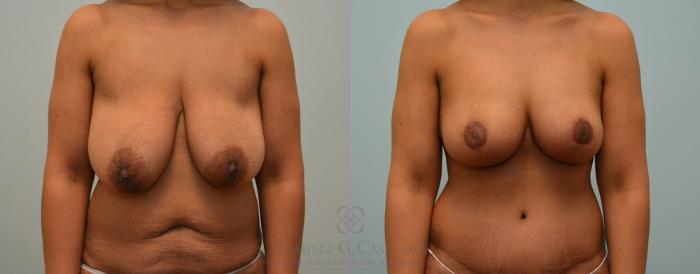 Before & After Post-Weight Loss Breast Enhancement Case 426 View #6 View in Houston, TX