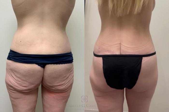 Before & After Post-Weight Loss Body Contouring Case 555 Back View in Houston, TX