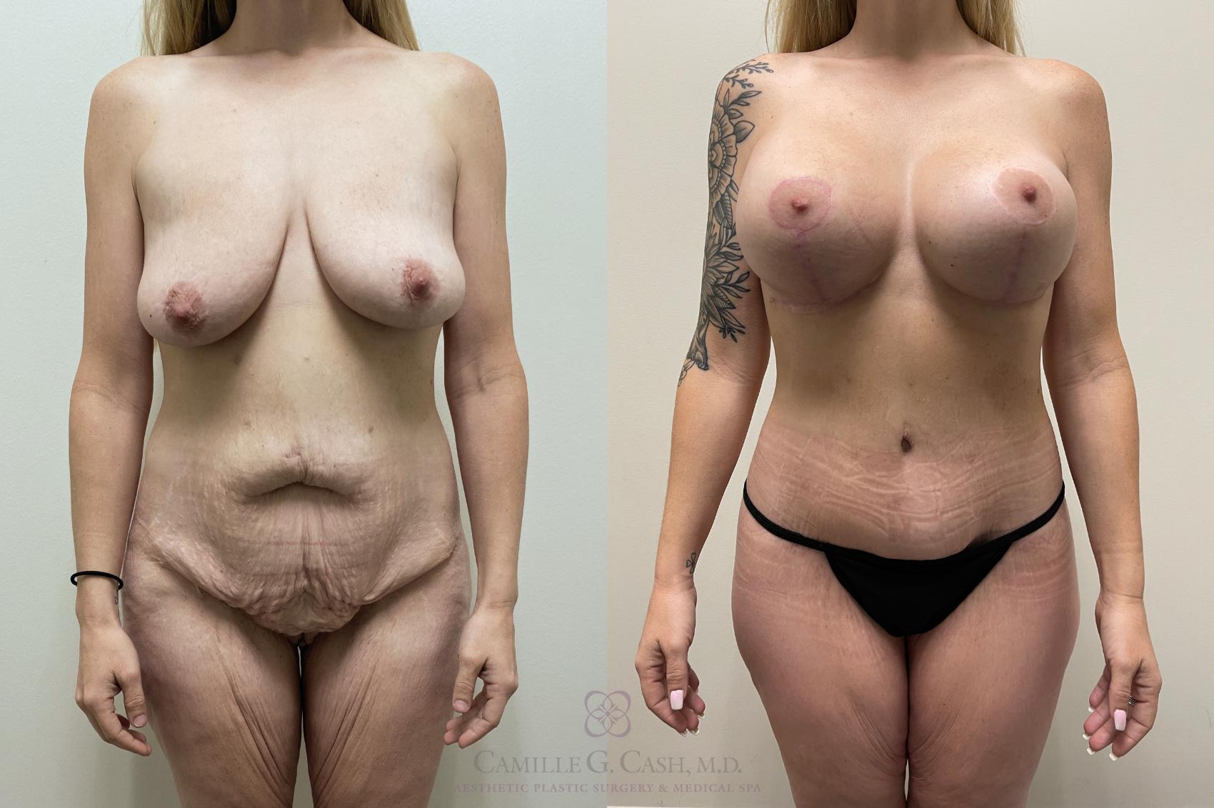 Before & After Post-Weight Loss Body Contouring Case 555 front 2 View in Houston, TX