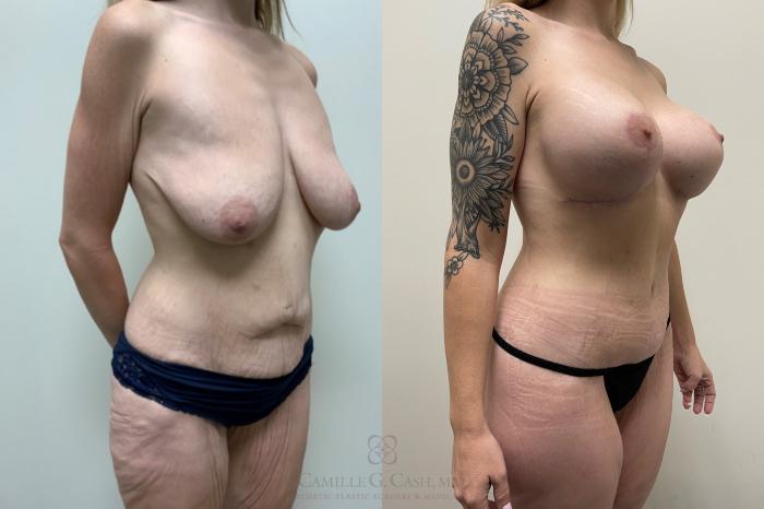 Before & After Post-Weight Loss Body Contouring Case 555 Left Oblique View in Houston, TX
