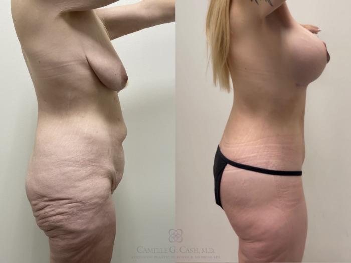 Before & After Post-Weight Loss Breast Enhancement Case 555 Left Side View in Houston, TX
