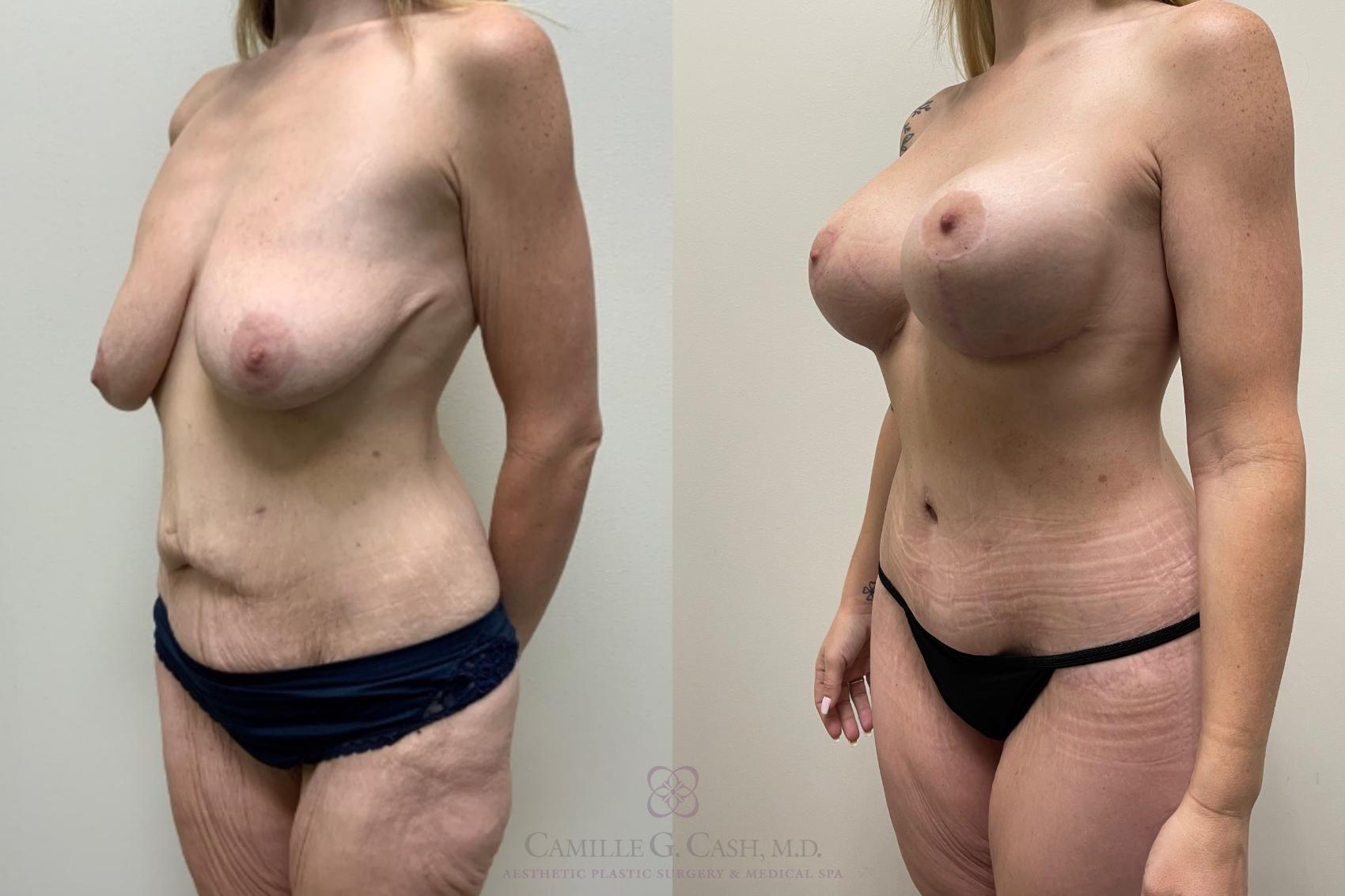 Before & After Post-Weight Loss Breast Enhancement Case 555 Right Oblique View in Houston, TX