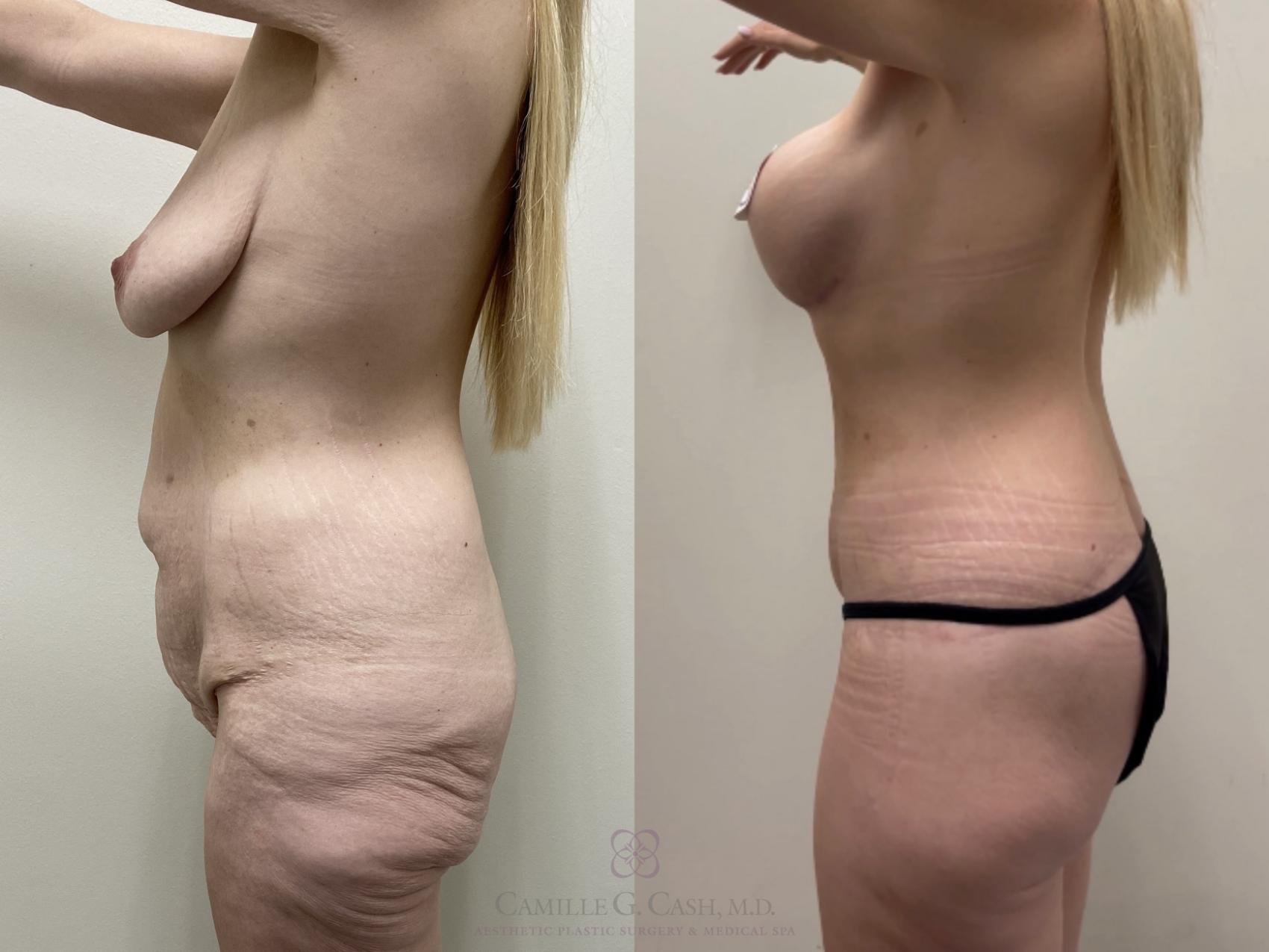 Before & After Body Lift Case 555 Right Side View in Houston, TX