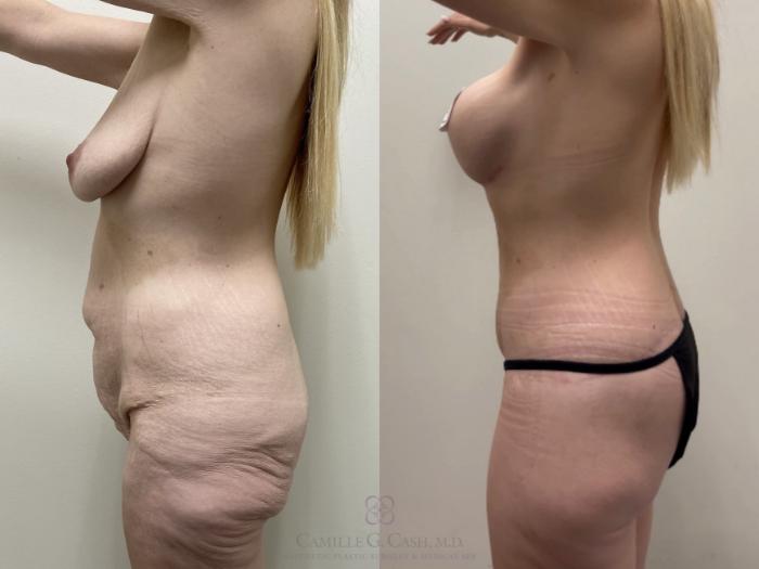 Before & After Post-Weight Loss Breast Enhancement Case 555 Right Side View in Houston, TX