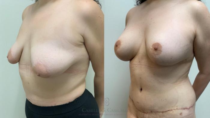 Before & After Post-Weight Loss Breast Enhancement Case 649 breasts left oblique View in Houston, TX