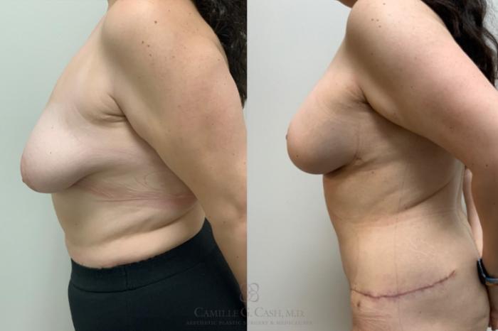 Before & After Post-Weight Loss Body Contouring Case 649 breasts left side View in Houston, TX