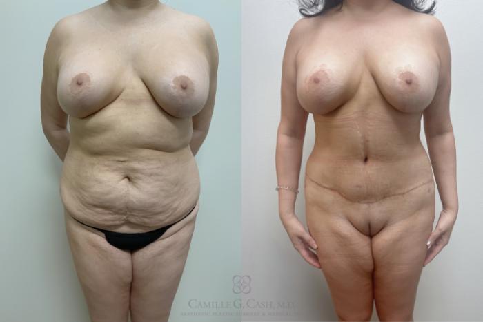Before & After Post-Weight Loss Breast Enhancement Case 649 front 3 mo after tt View in Houston, TX