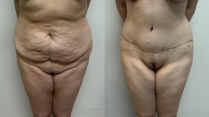 Before & After Post-Weight Loss Breast Enhancement Case 649 front abs View in Houston, TX