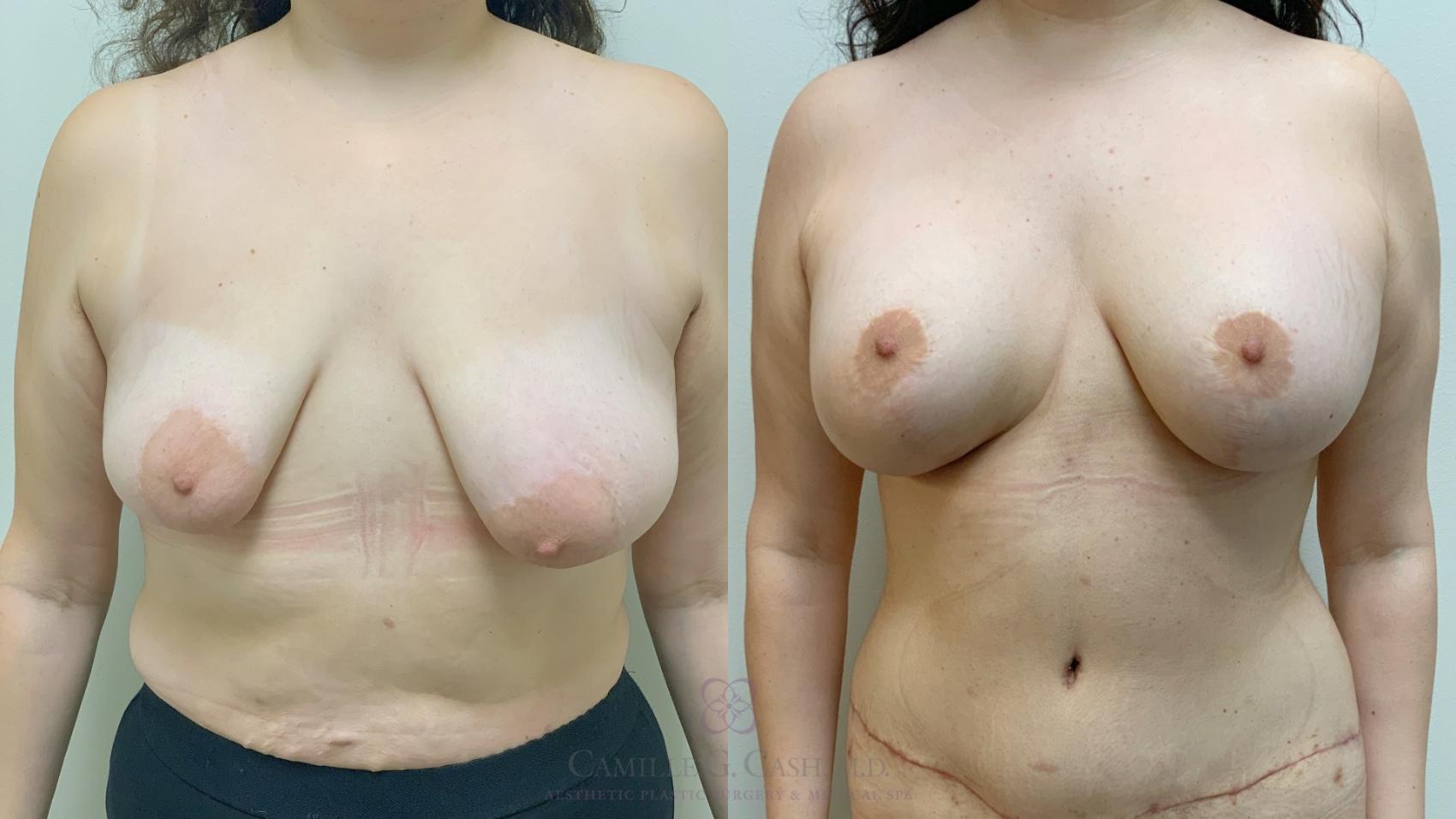Before & After Post-Weight Loss Body Contouring Case 649 Front View in Houston, TX