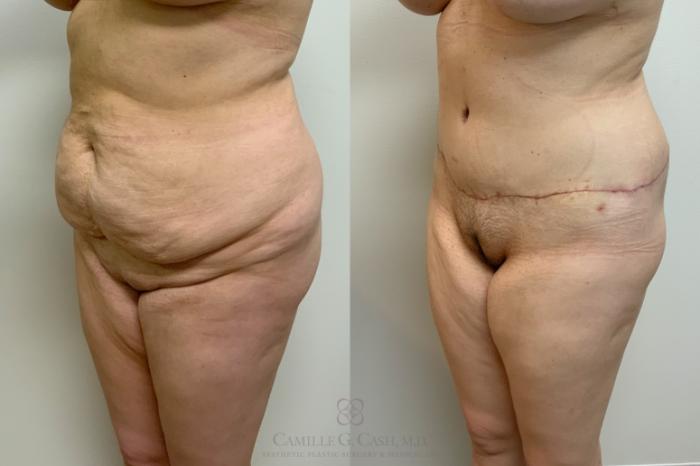 Before & After Post-Weight Loss Breast Enhancement Case 649 Left Oblique View in Houston, TX