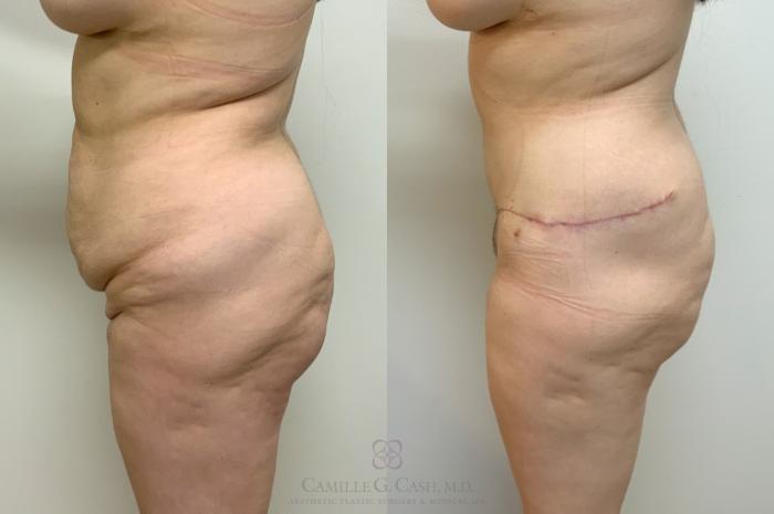 Before & After Post-Weight Loss Body Contouring Case 649 Left Side View in Houston, TX