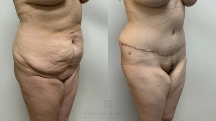 Before & After Post-Weight Loss Body Contouring Case 649 right ab ob View in Houston, TX