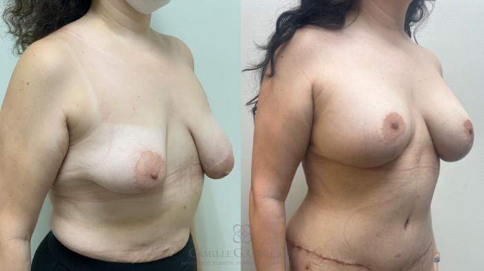Before & After Post-Weight Loss Breast Enhancement Case 649 Right Oblique View in Houston, TX