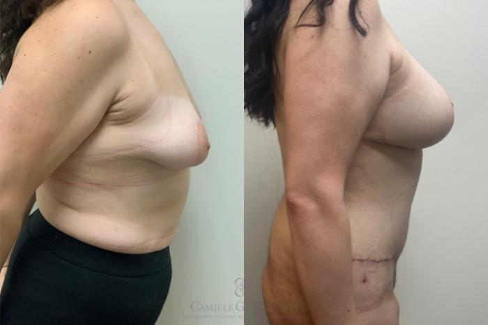 Before & After Post-Weight Loss Breast Enhancement Case 649 Right Side View in Houston, TX