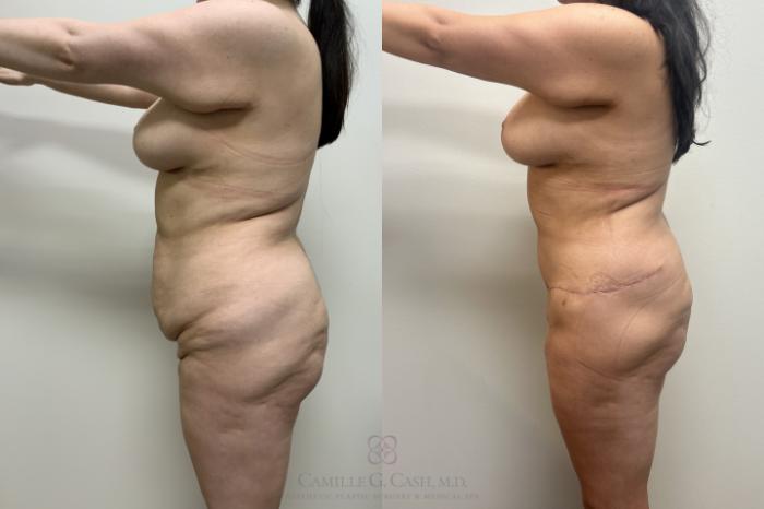 Before & After Post-Weight Loss Breast Enhancement Case 649 side 3 months post-op Abdominoplasty without muscle plication and liposuction of Lower Back. View in Houston, TX