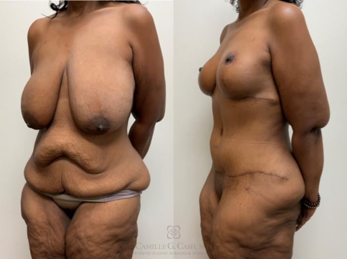 Before & After Post-Weight Loss Body Contouring Case 680 Left Oblique View in Houston, TX