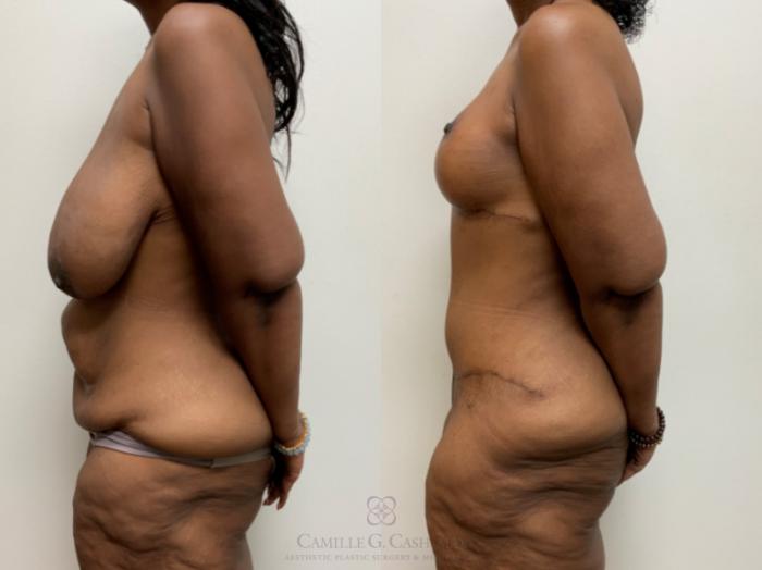 Before & After Post-Weight Loss Body Contouring Case 680 Left Side View in Houston, TX
