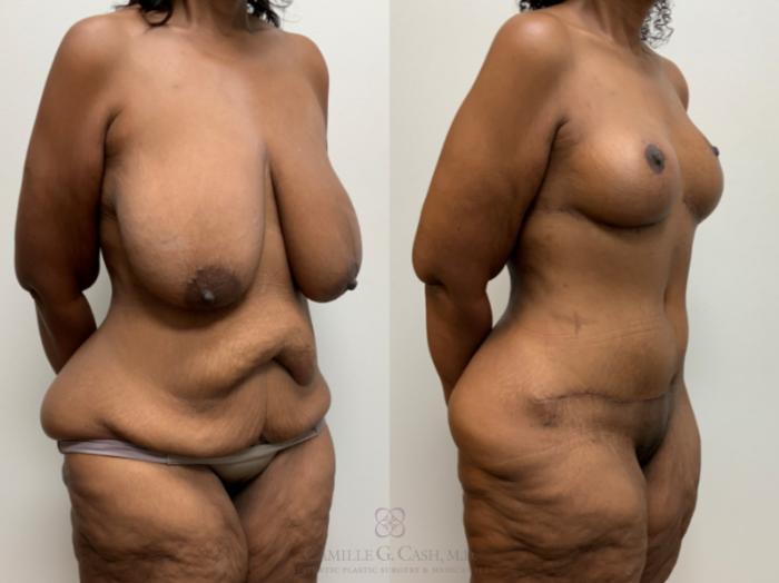 Before & After Post-Weight Loss Body Contouring Case 680 Right Oblique View in Houston, TX