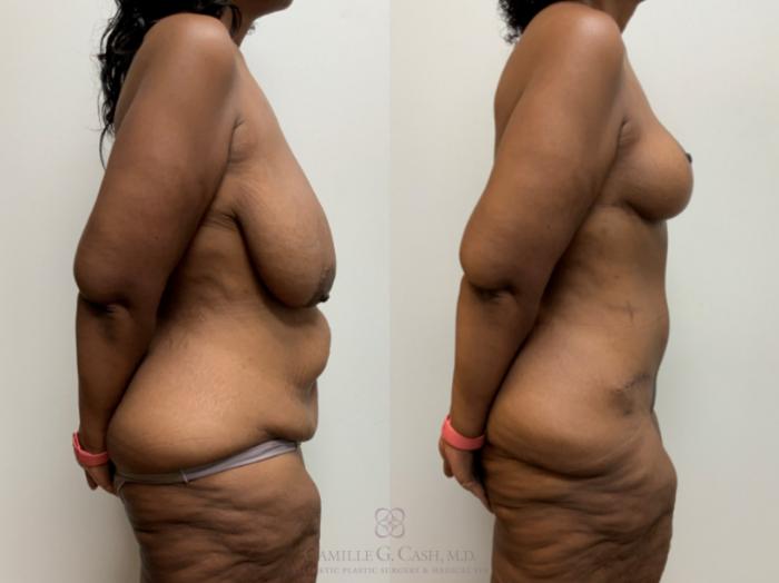 Before & After Post-Weight Loss Body Contouring Case 680 Right Side View in Houston, TX
