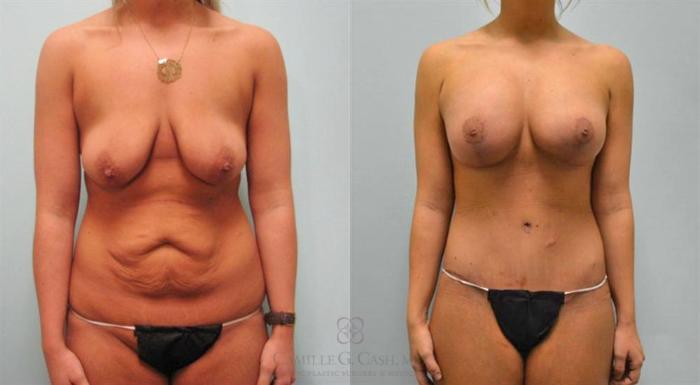 Before & After Post-Weight Loss Breast Enhancement Case 97 View #1 View in Houston, TX