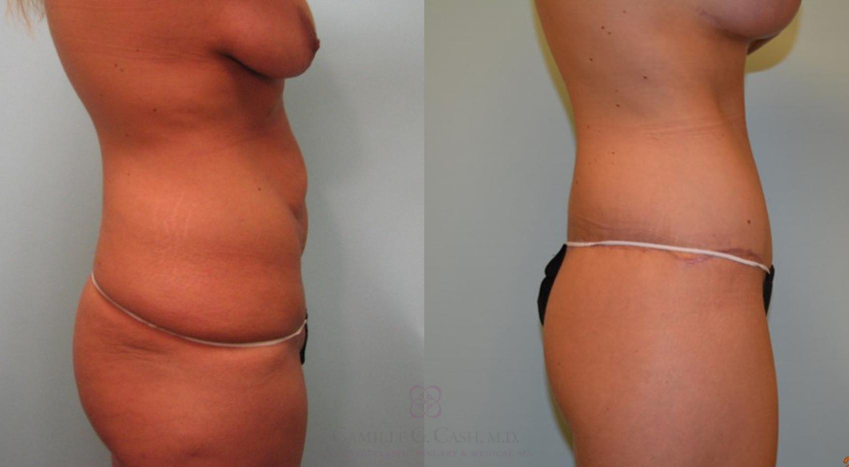 Before & After Post-Weight Loss Body Contouring Case 97 View #2 View in Houston, TX