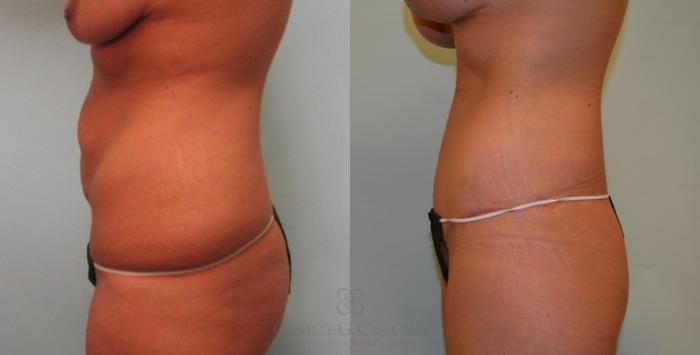 Before & After Post-Weight Loss Breast Enhancement Case 97 View #3 View in Houston, TX