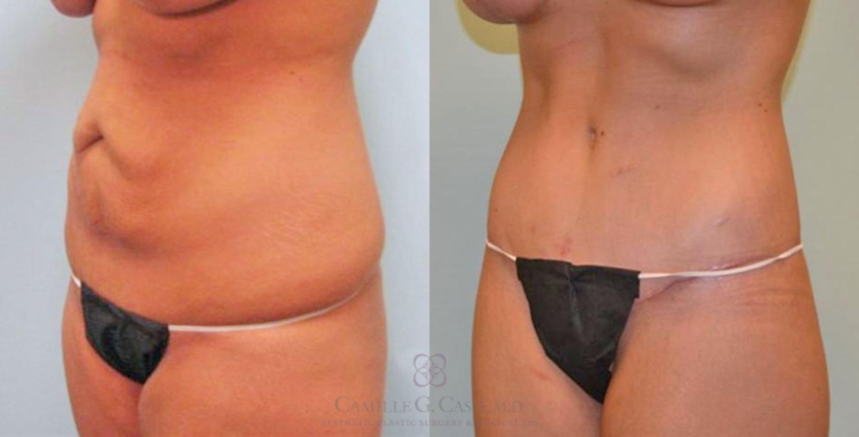 Before & After Post-Weight Loss Breast Enhancement Case 97 View #4 View in Houston, TX