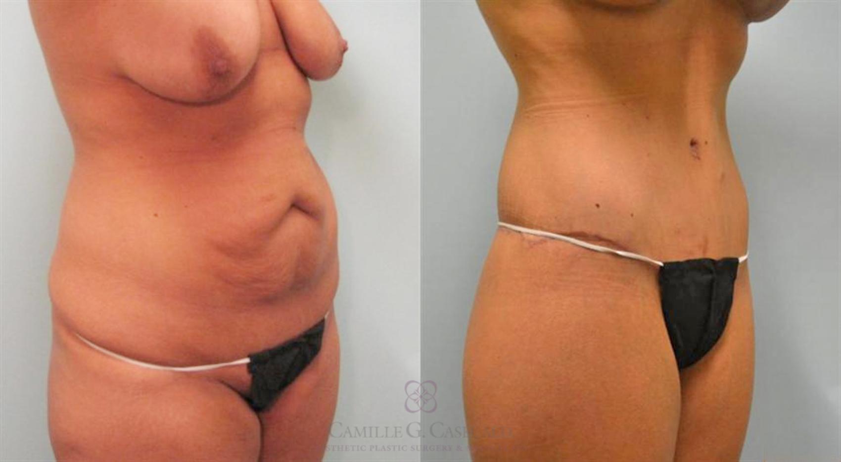 Before & After Post-Weight Loss Breast Enhancement Case 97 View #5 View in Houston, TX