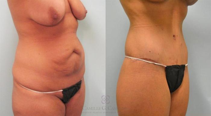 Before & After Post-Weight Loss Breast Enhancement Case 97 View #5 View in Houston, TX