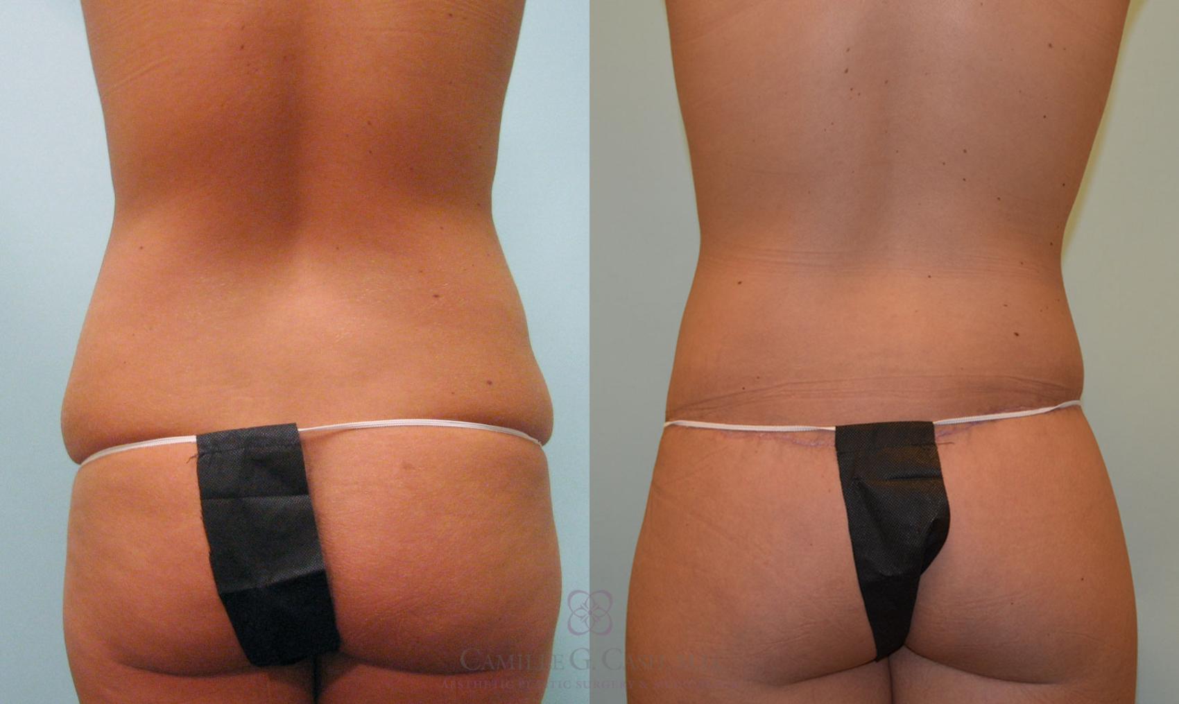 Before & After Post-Weight Loss Body Contouring Case 97 View #6 View in Houston, TX