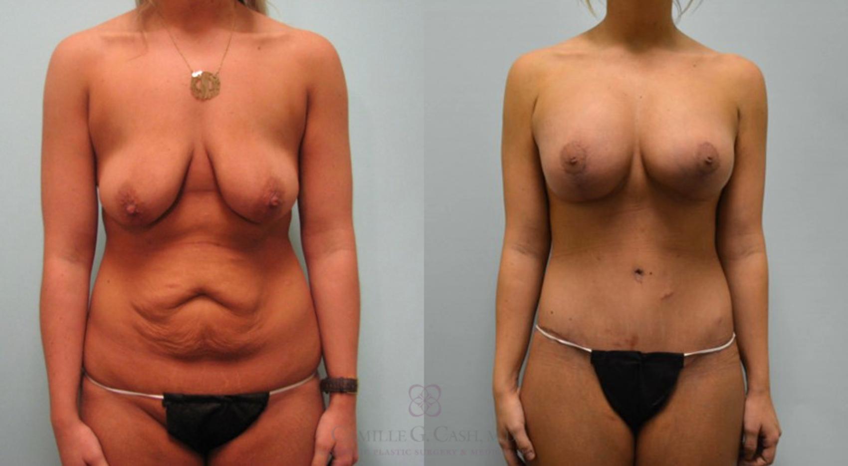 Before & After Post-Weight Loss Body Contouring Case 97 View #7 View in Houston, TX