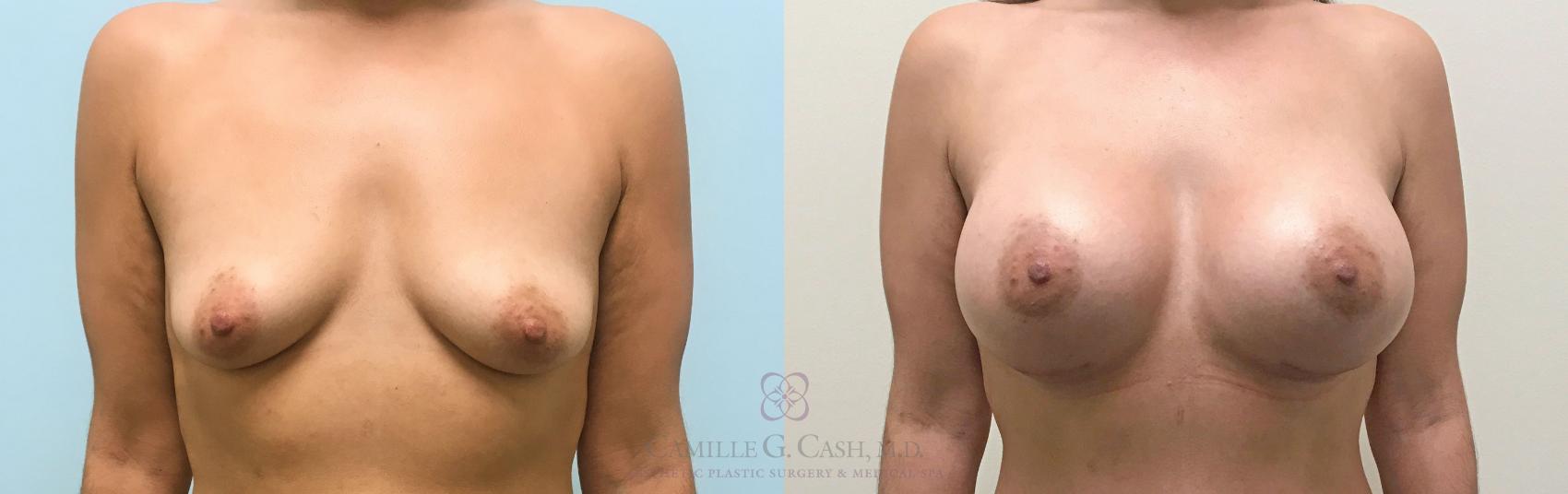 Before & After Post-Weight Loss Breast Enhancement Case 311 View #1 View in Houston, TX