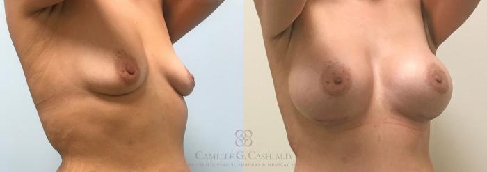 Before & After Post-Weight Loss Breast Enhancement Case 311 View #2 View in Houston, TX