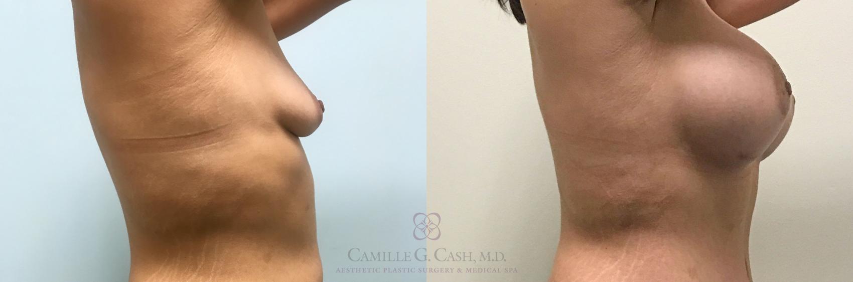 Before & After Post-Weight Loss Breast Enhancement Case 311 View #3 View in Houston, TX