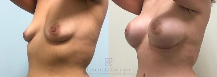 Before & After Post-Weight Loss Breast Enhancement Case 311 View #4 View in Houston, TX