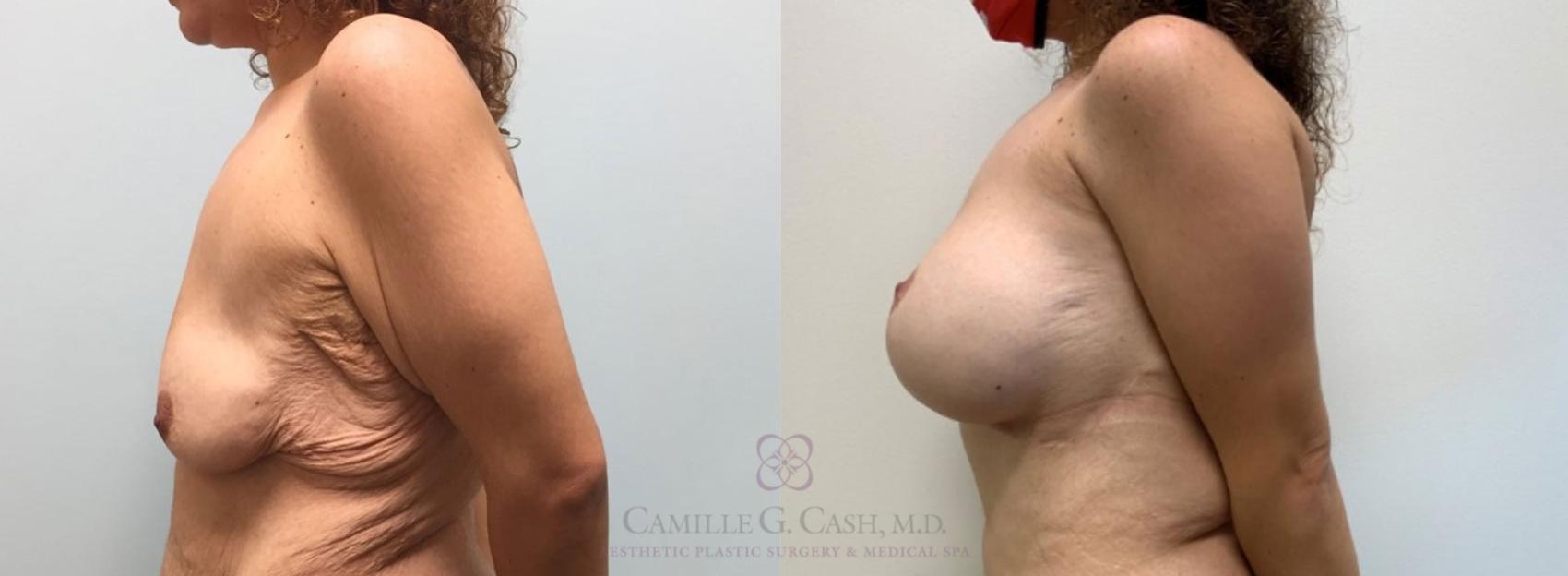 Before & After Post-Weight Loss Breast Enhancement Case 316 View #3 View in Houston, TX