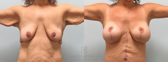 Before & After Post-Weight Loss Breast Enhancement Case 316 View #4 View in Houston, TX