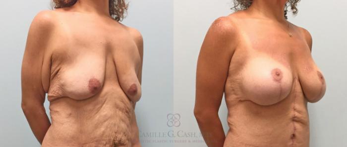 Before & After Post-Weight Loss Breast Enhancement Case 316 View #5 View in Houston, TX