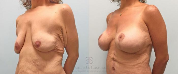 Before & After Post-Weight Loss Breast Enhancement Case 316 View #6 View in Houston, TX