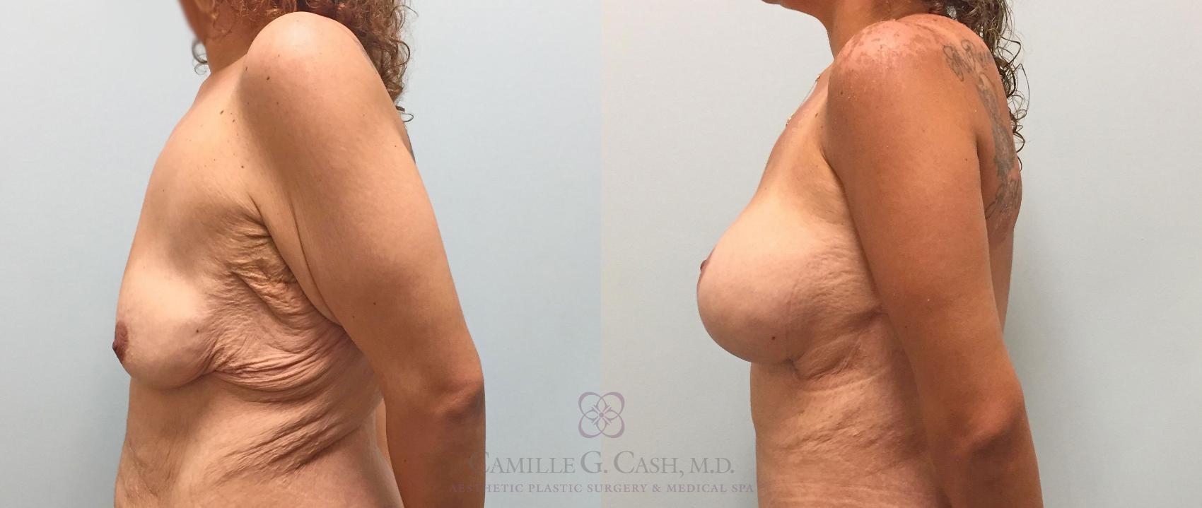 Before & After Post-Weight Loss Breast Enhancement Case 316 View #7 View in Houston, TX