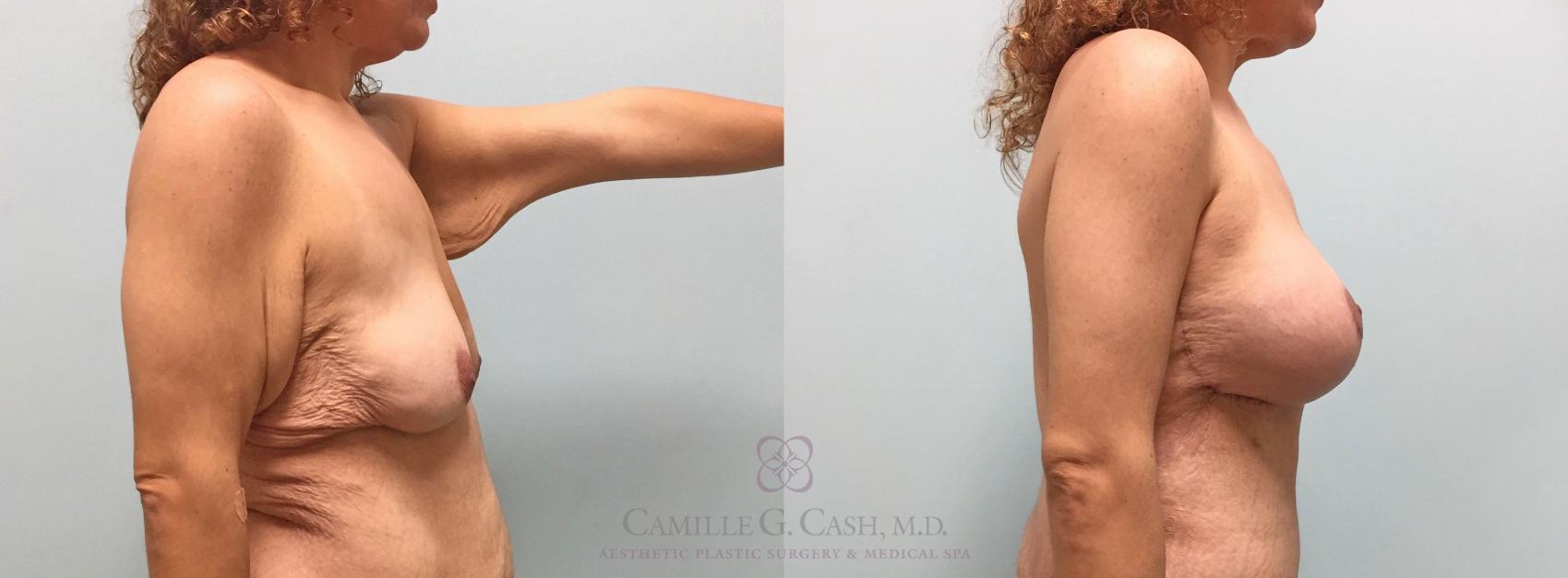 Before & After Post-Weight Loss Breast Enhancement Case 316 View #8 View in Houston, TX