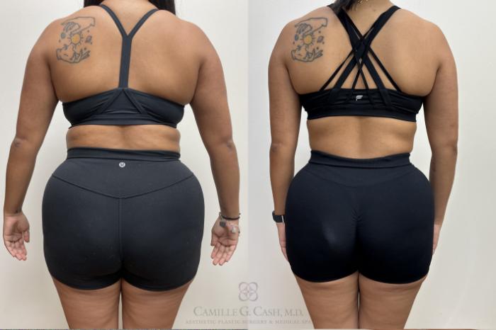 Before & After Semaglutide Weight Loss Case 690 Back View in Houston, TX