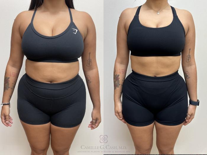 Before & After Semaglutide Weight Loss Case 690 Front View in Houston, TX