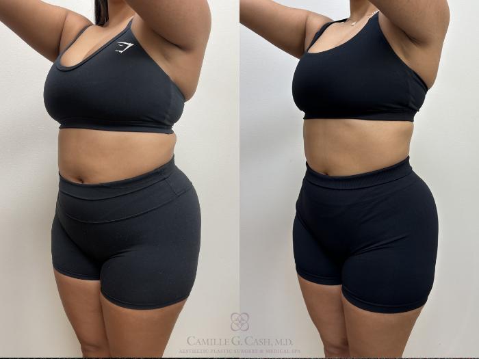 Before & After Semaglutide Weight Loss Case 690 Left Oblique View in Houston, TX