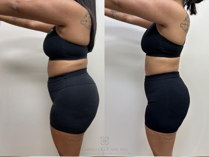 Before & After Semaglutide Weight Loss Case 690 Left Side View in Houston, TX