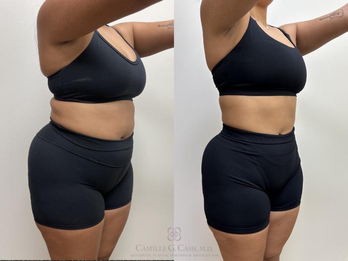 Before & After Semaglutide Weight Loss Case 690 Right Oblique View in Houston, TX