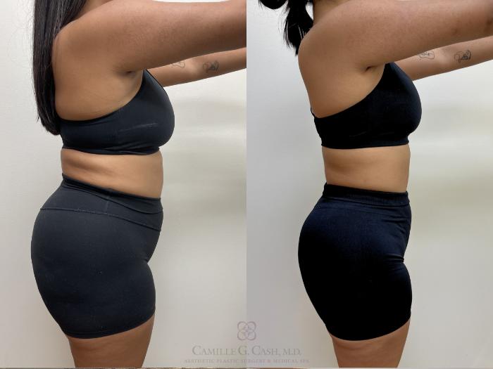 Before & After Semaglutide Weight Loss Case 690 Right Side View in Houston, TX