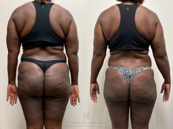 Before & After Semaglutide Weight Loss Case 691 Back View in Houston, TX