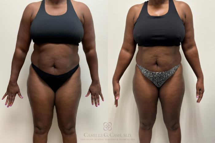 Before & After Semaglutide Weight Loss Case 691 Front View in Houston, TX